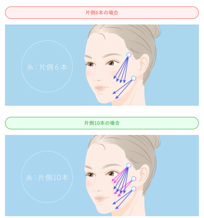 TCBの糸リフトは何本入れる？片側6本、10本の場合例